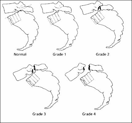 Boční pohled na poslední bederní obratel a křížovou 
  kost se čtyřmi stupni spondylolistézy (Brox JI, 2003).