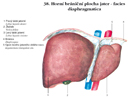 Horní brániční plocha jater - facies diaphragmatica