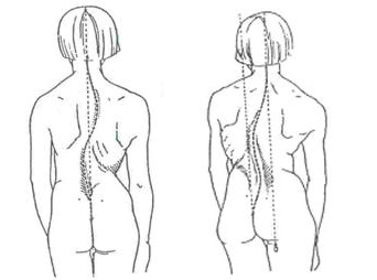 Obr. 4 Hodnocení postavení páteře podle olovnice-kompenzovaná a dekompenzovaná skolióza (Haladová, Nechvátalová 1997)