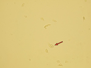 Transitional epithelial cell with two nuclei