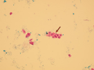 Fragments of renal tubular epithelia