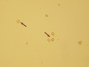 Renal tubular epithelia probably from proximal tubules