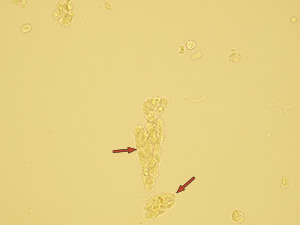 Fragments of renal tubular epithelia