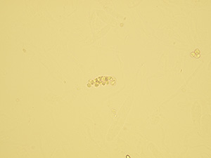 Leukocyte cast