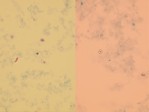 Oxalate dihydrate crystals with an erythrocyte; oxalate crystals