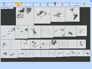 Fecal particles (black elements) miscategorized in squamous epithelia section