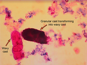 Transition phase of cast from granular to waxy and waxy cast