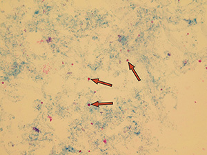 Dysmorfní erytrocyty – akantocyty