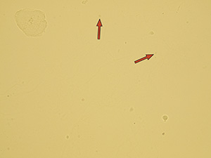 Dysmorphic cells – codocytes