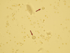 Leukocytes including macrophages (arrows)