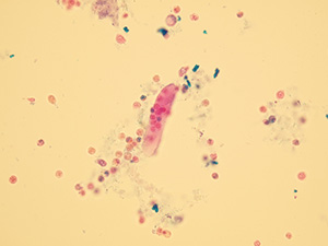 Hyaline cast with leukocytes inside