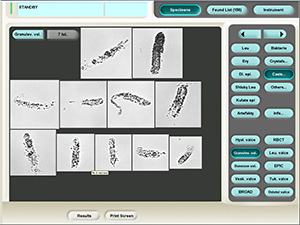 Granular casts fotografie z přístroje iQ 200)