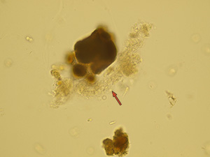 Pseudocast – ammonium urate crystals (arrow)