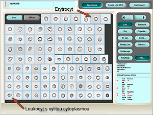 Leukocyty (třpytivé buňky) a erytrocyty zařazené v kategoii leukocytů