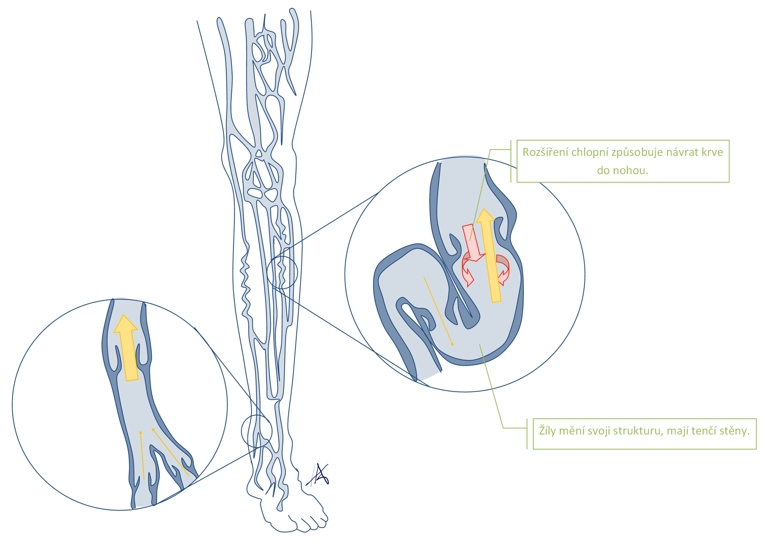 Vznik žilní insuficience vedoucí ke vzniku tzv. křečových žil. Žíla ztrácí svou funkci a vede ke stagnaci krve v končetinách.