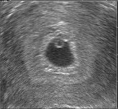 Ultrasonografie: 5. týden – gestační váček