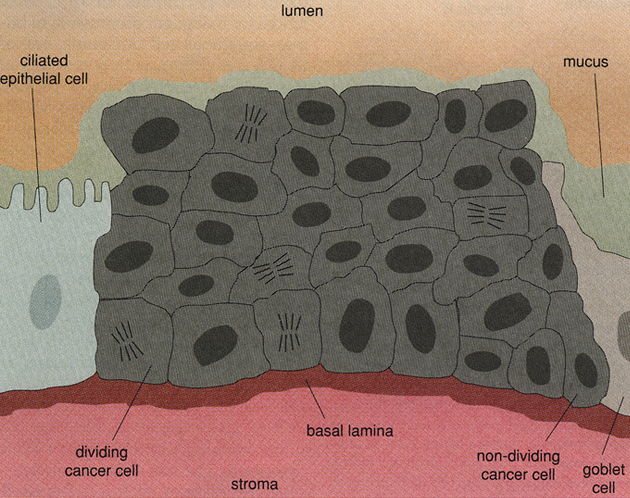 Karcinom in situ