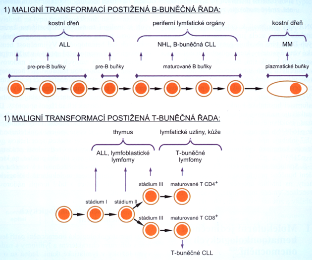 Typ hematoonkologického onemocnění, které se bude vyvíjet, závisí na vývojovém stadiu lymfoidní prekurzorové buňky zasažené maligní transformací.