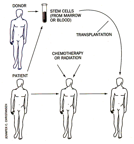 Transplantace