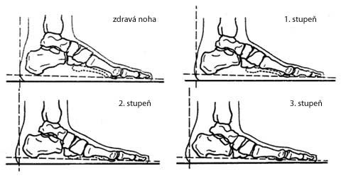 Obr. 34: Zdravá a tři stupně ploché nohy (viz 1)