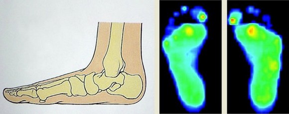 Obr. 31: plochá noha a tlakový snímek plochých nohou (viz 1) 