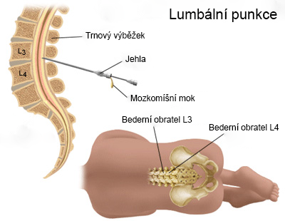 Lumbální punkce 