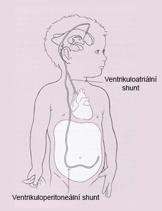 Ventrikuloperitoenální a ventrikuloatriální drenáž