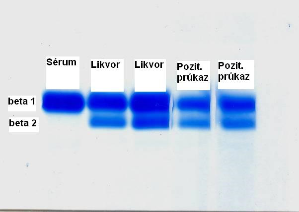 Průkaz likvorey – pozitivní