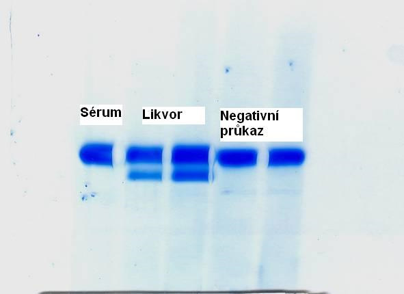 Průkaz likvorey – negativní